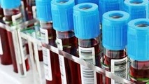 تشخیص زودهنگام آلزایمر با مطالعه روی پروتئین‌های خون
